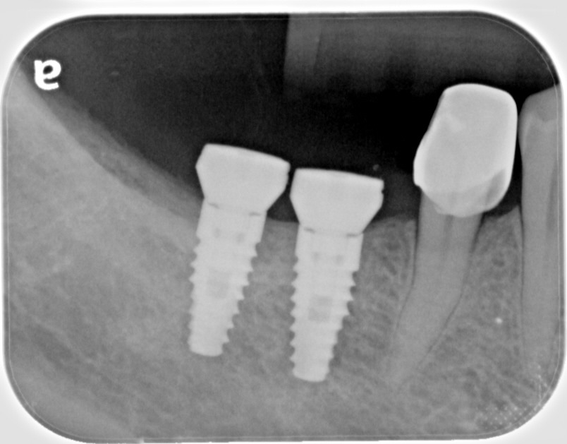 dental implants