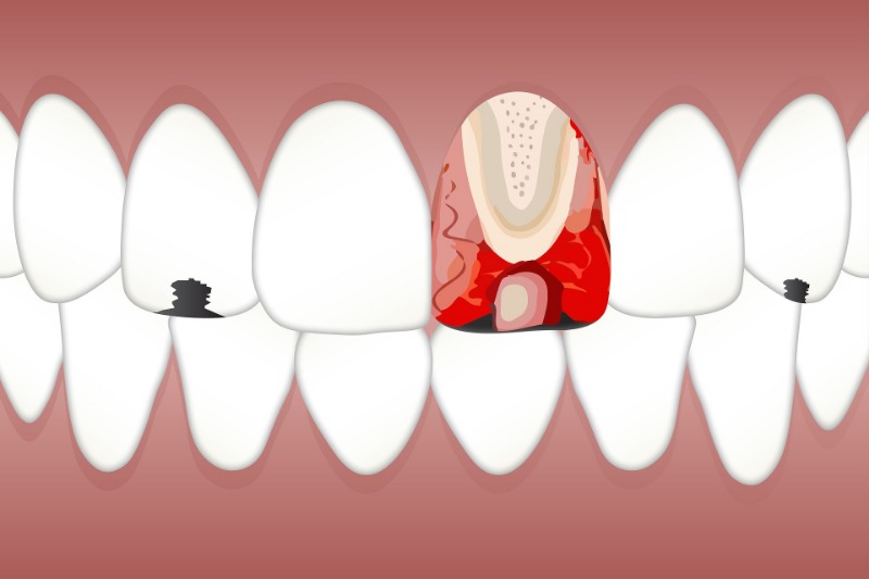 Dental Trauma Treatment in Glendale - Smile Makeover of LA