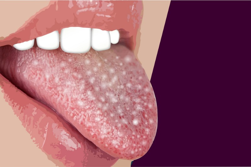 What does thrush look deals like on the tongue