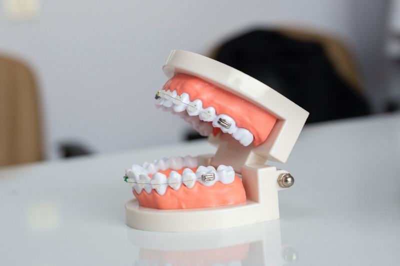 Can You Get Your Teeth Cleaned While Wearing Braces?