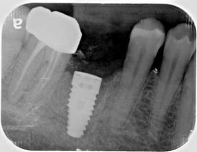 dental implants