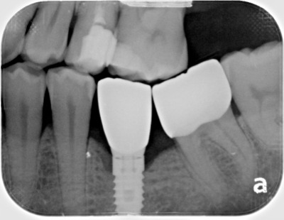 dental implants