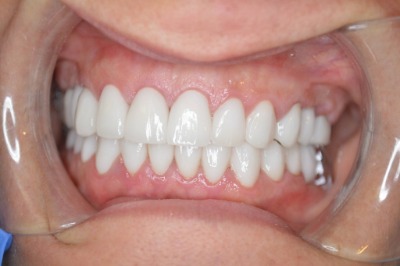 Invisalign