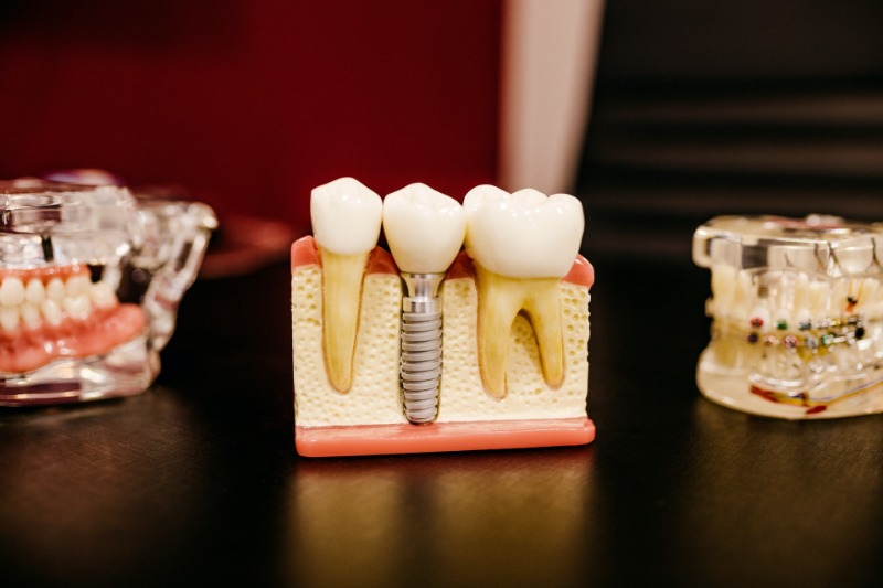 Dentist Glendale Dental Implant Crown Types - Smile Makeover of LA