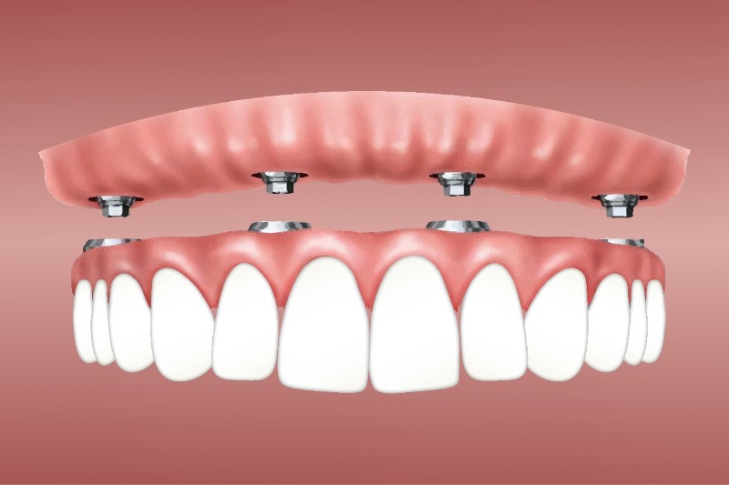 Which Dental Crown Material is Best?