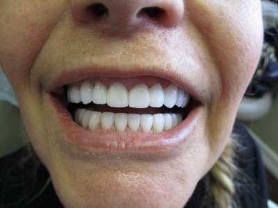 mouth restoration