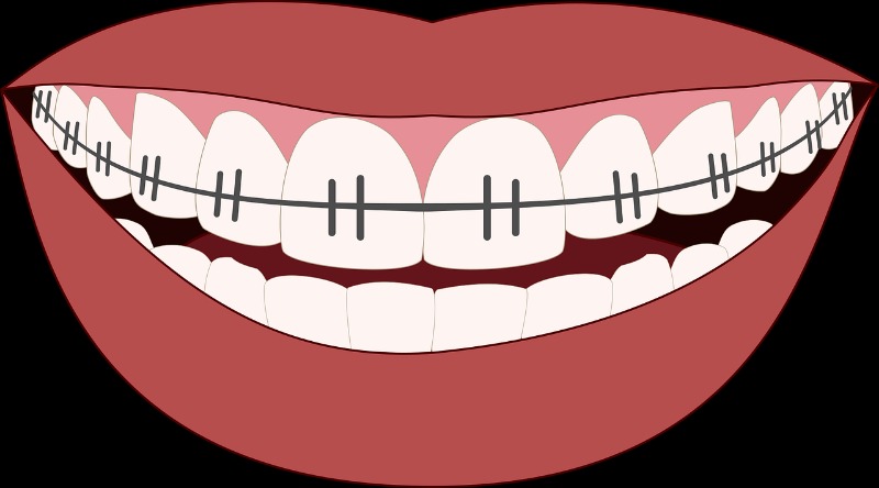 The History and Origins of Traditional Braces