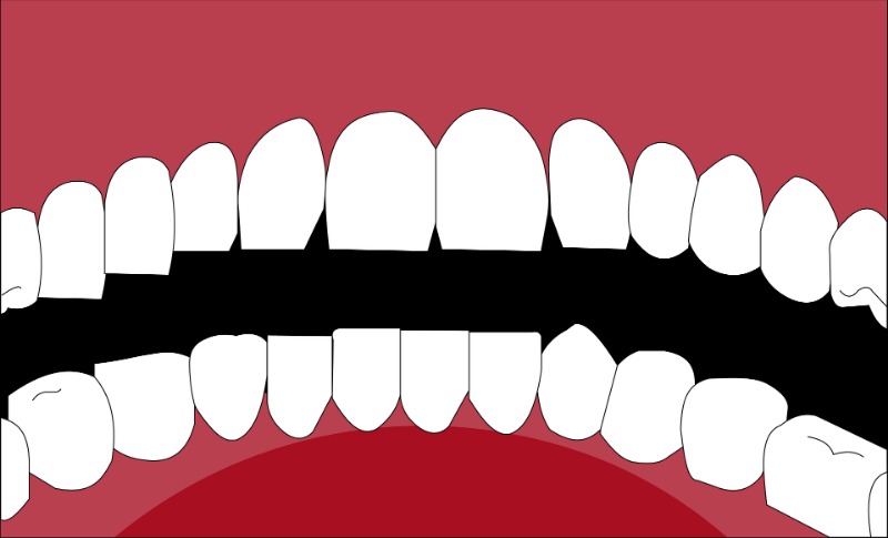 How to Deal with a Broken Tooth Emergency? - Smile Makeover of LA