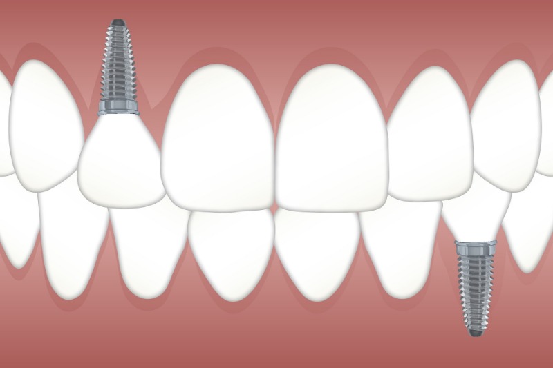 10 Effective Ways To Get More Out Of front tooth composite fillings