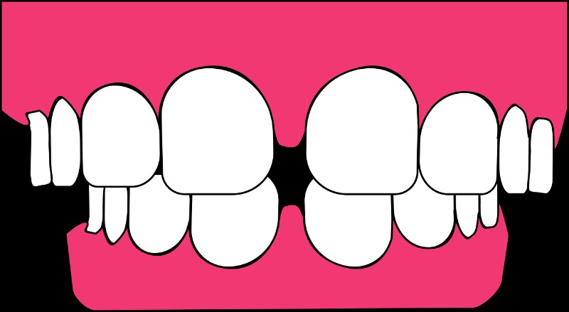 teeth gaps