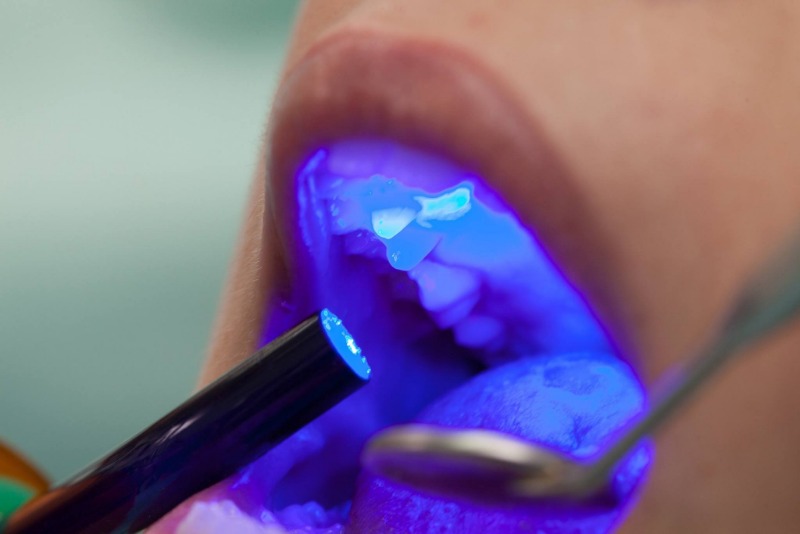 teeth whitening